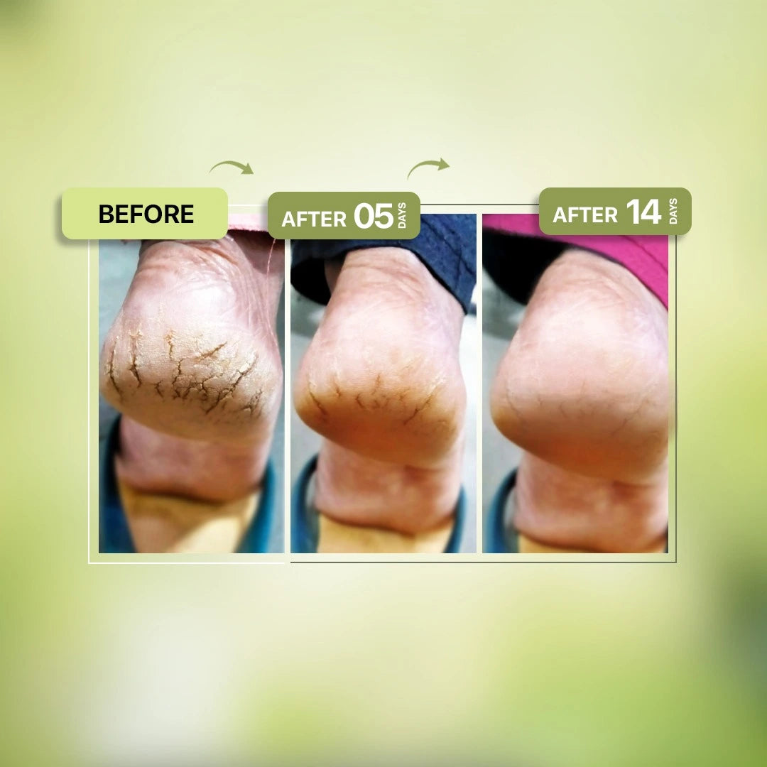 Dhathri crack foot cream