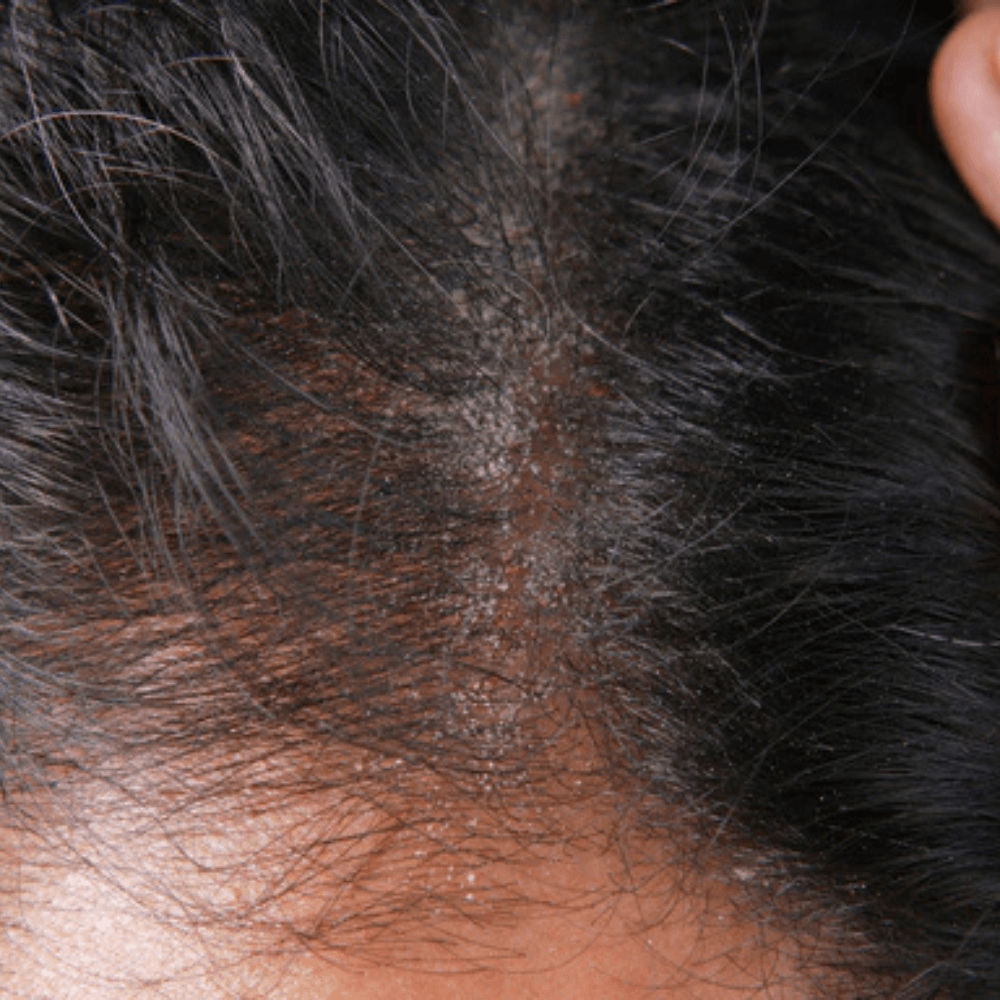 Dry Scalp